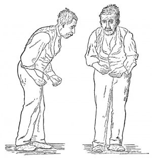 Blocq’s Disease: When the Body Speaks the Mind